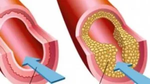 4 Makan yang Mengandung Kolesterol Tinggi